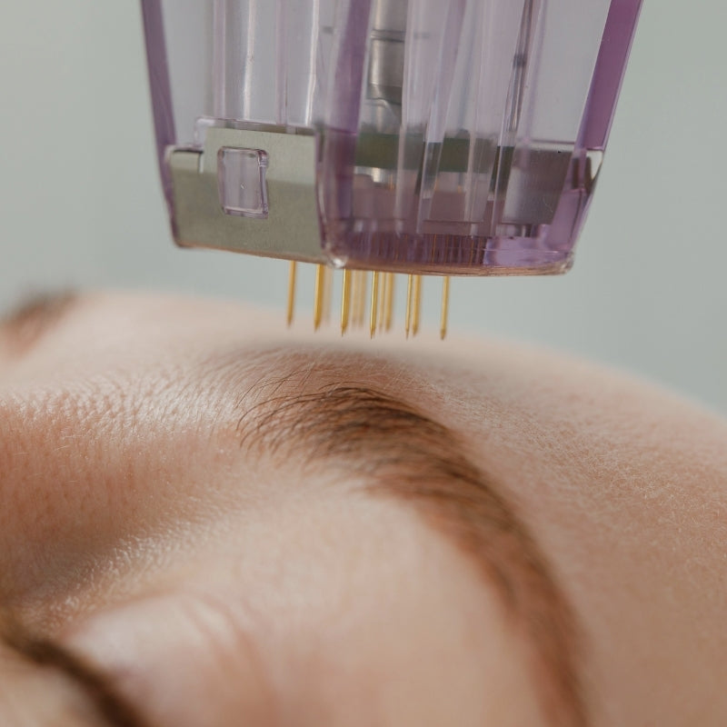 Close up of microneedling device 